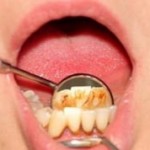 Чем зубной налет отличается от зубного камня