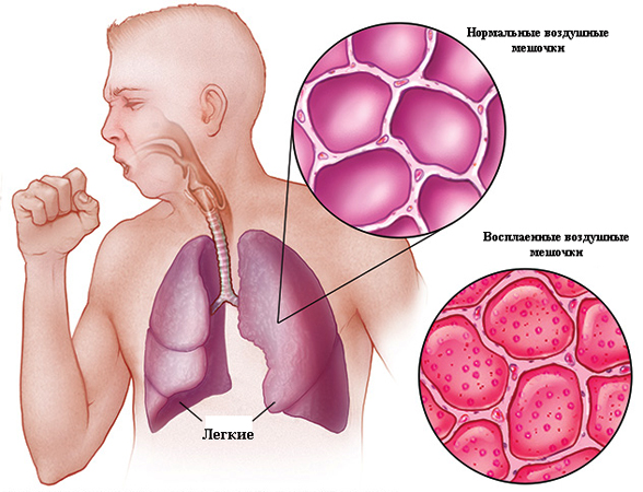 Как проявляется пневмония