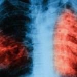 Чем отличается пневмония от туберкулеза: особенности болезней