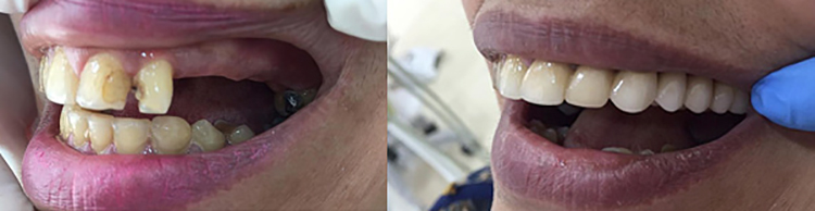 До и после установки зубного моста