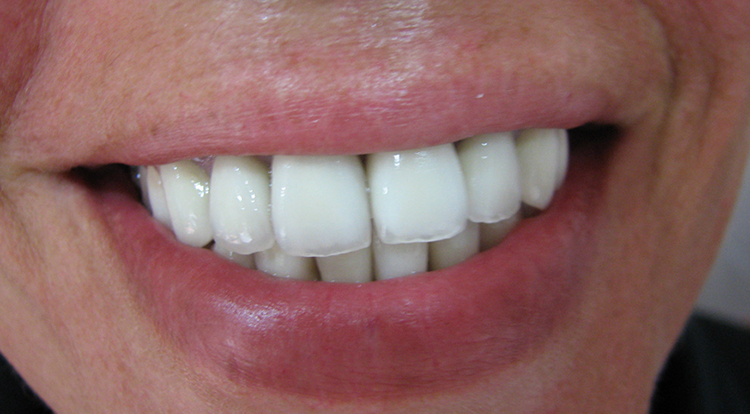 Зубы с металлокерамикой