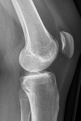 Рентгеновский снимок колена