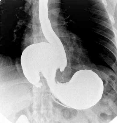 Рентгеновский снимок желудка